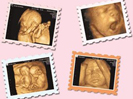 四维彩超对胎儿有辐射吗